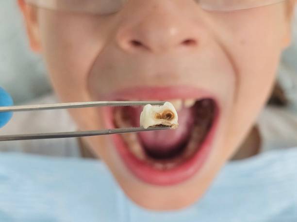 Best Emergency Tooth Extraction in Druid Hills, GA
